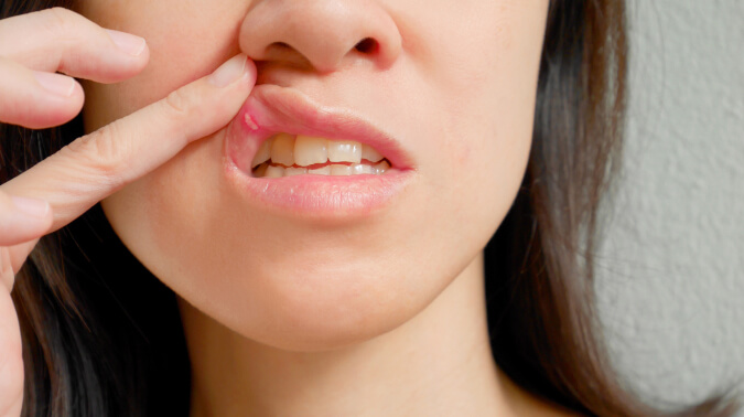 Язвы во рту у взрослого
