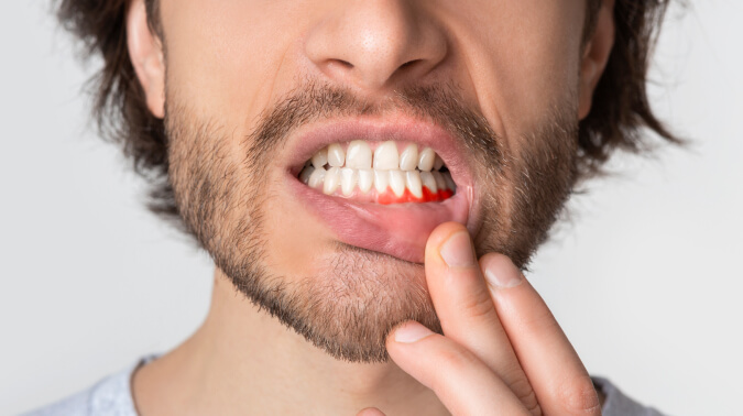 Курение и десны: как сигареты влияют на полость рта?