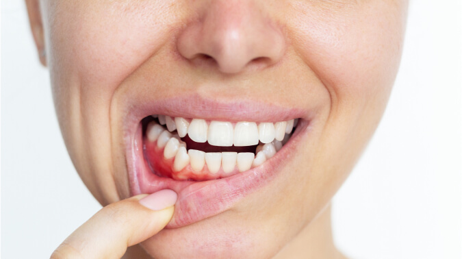 Воспаление десен